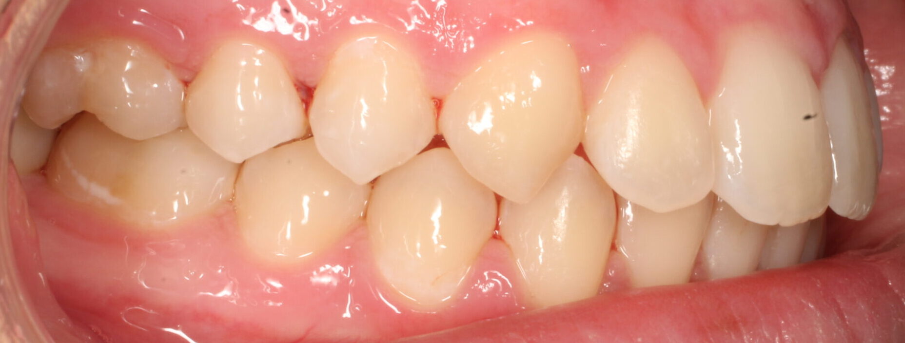 After braces right teeth