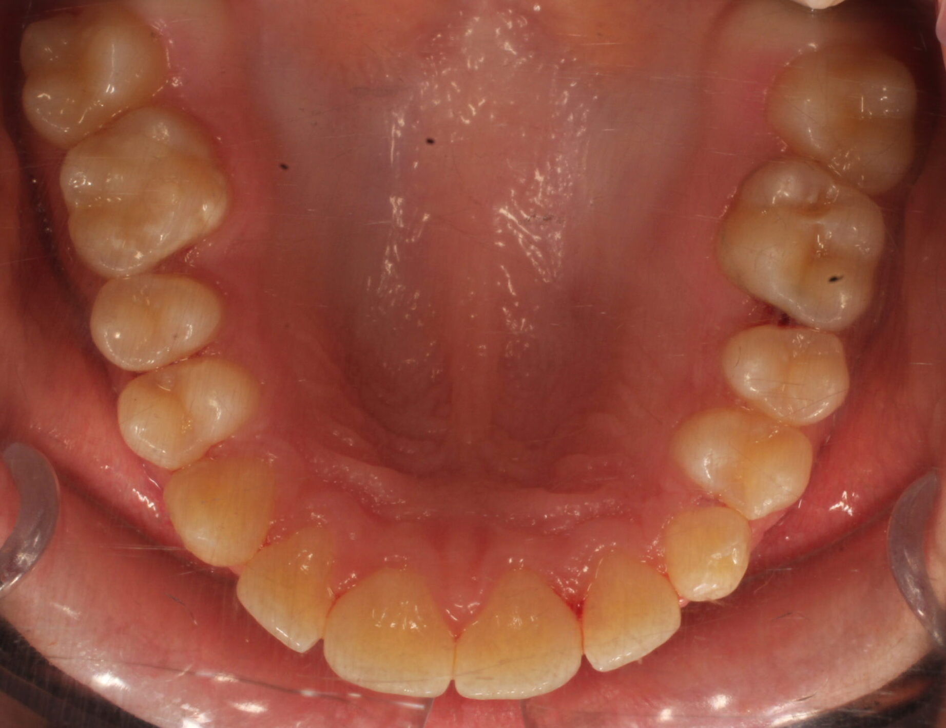 After braces upper teeth