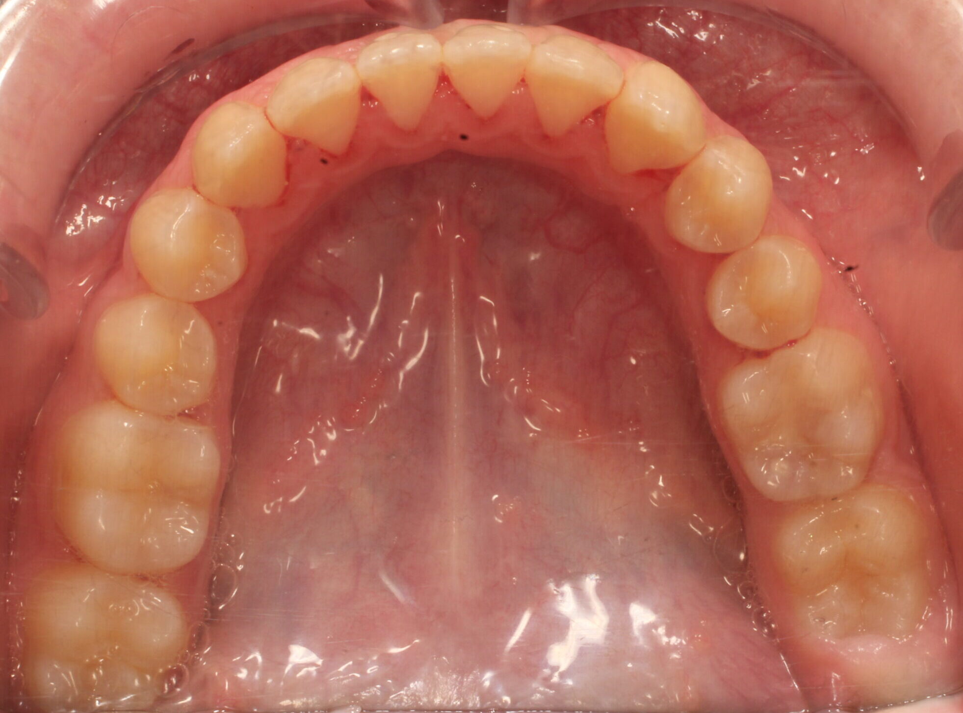 After braces lower teeth