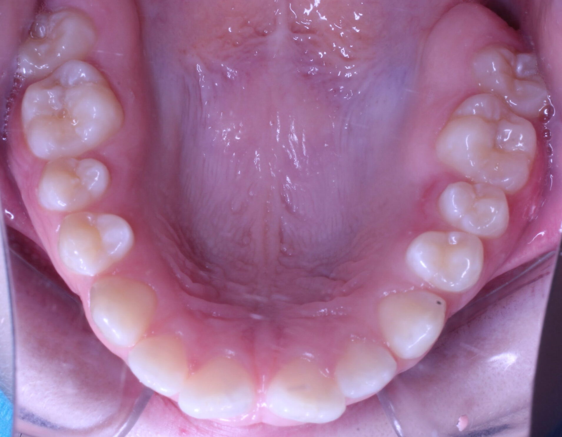 Before braces upper teeth