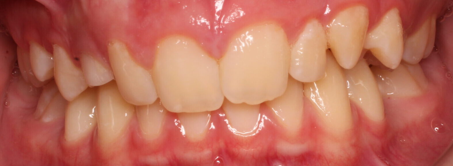 Before braces front teeth