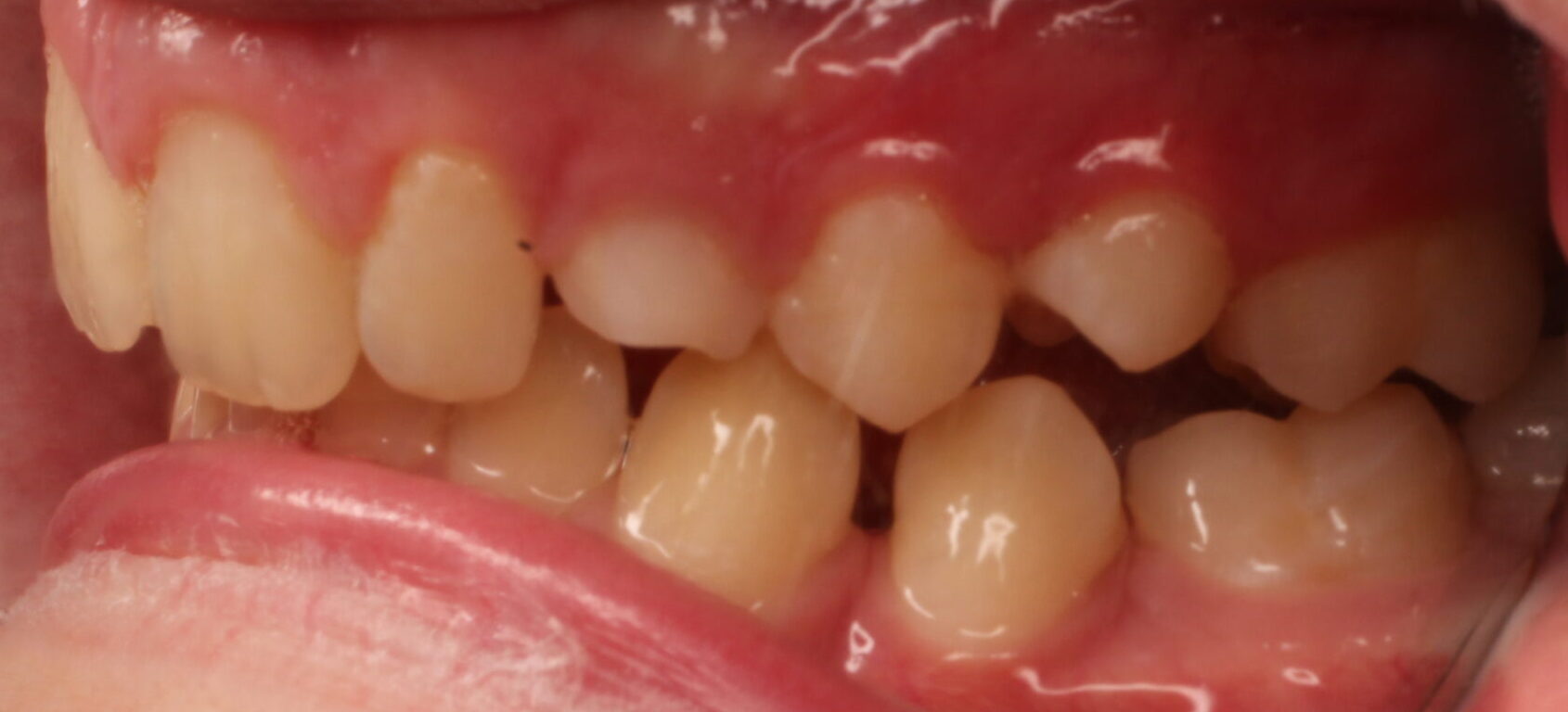 Before braces left teeth