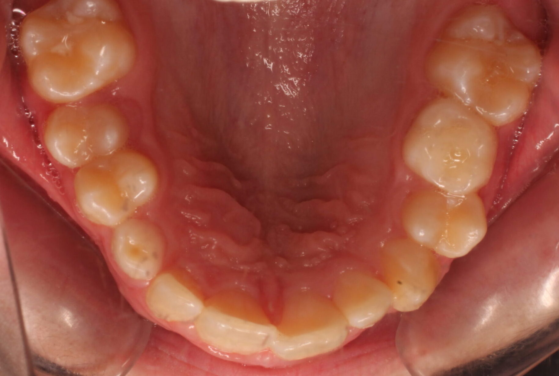 Before braces upper teeth