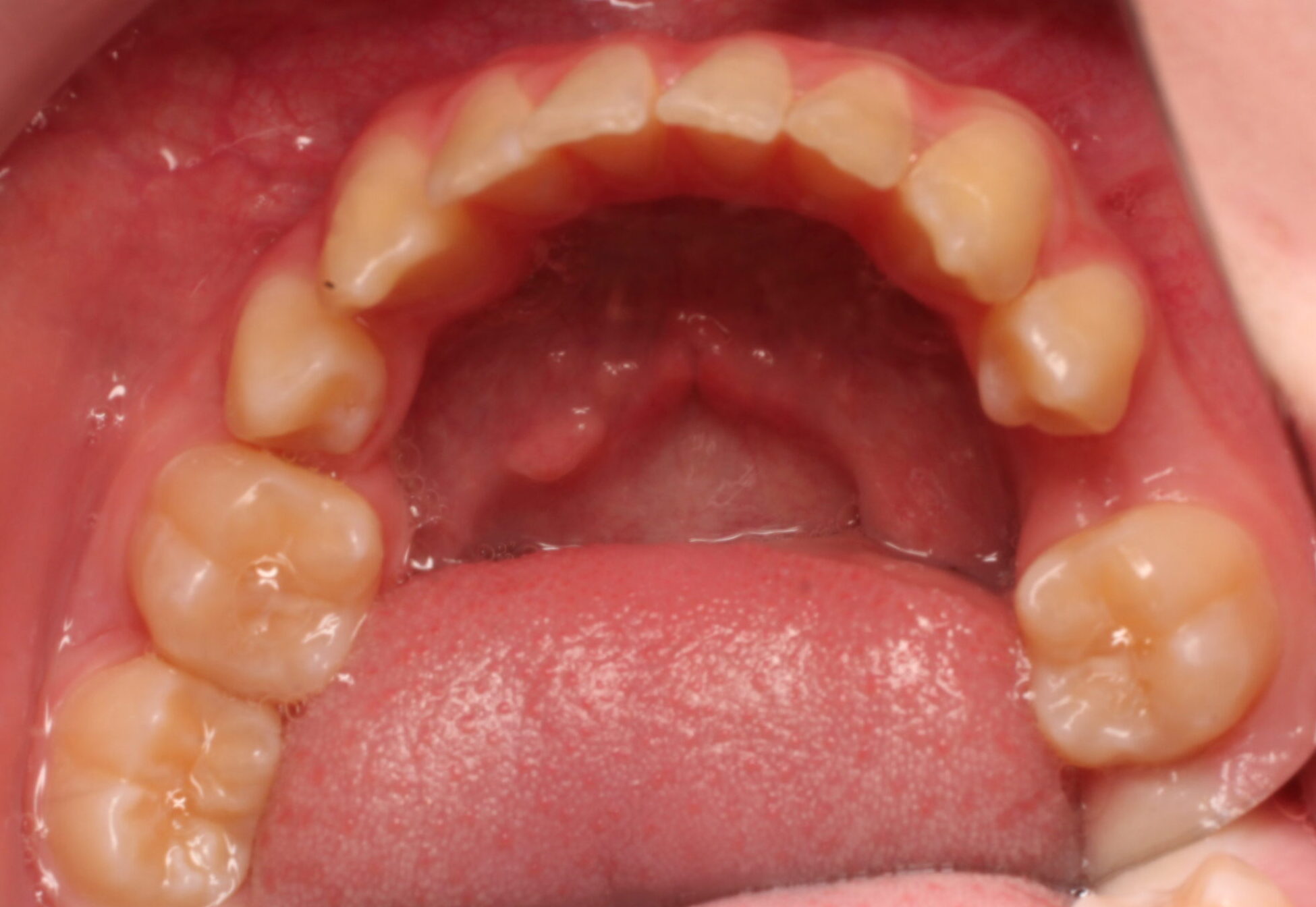 Before braces lower teeth