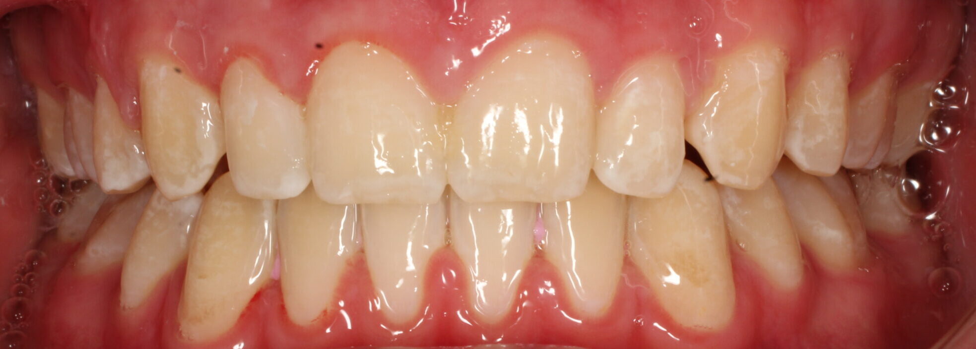 After braces front teeth