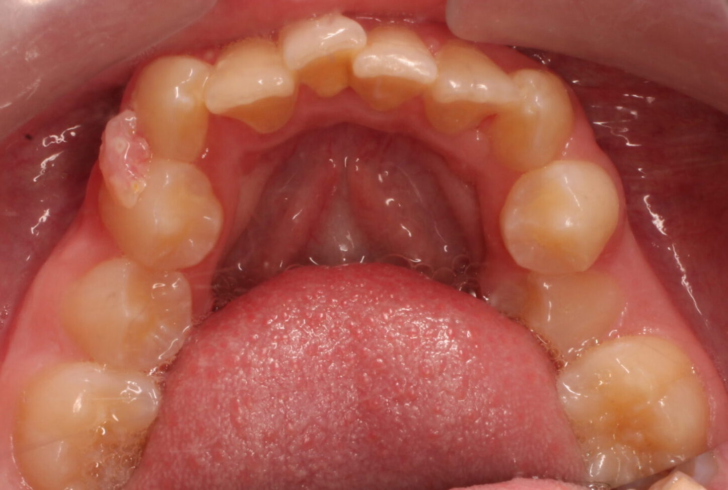 Before braces lower teeth
