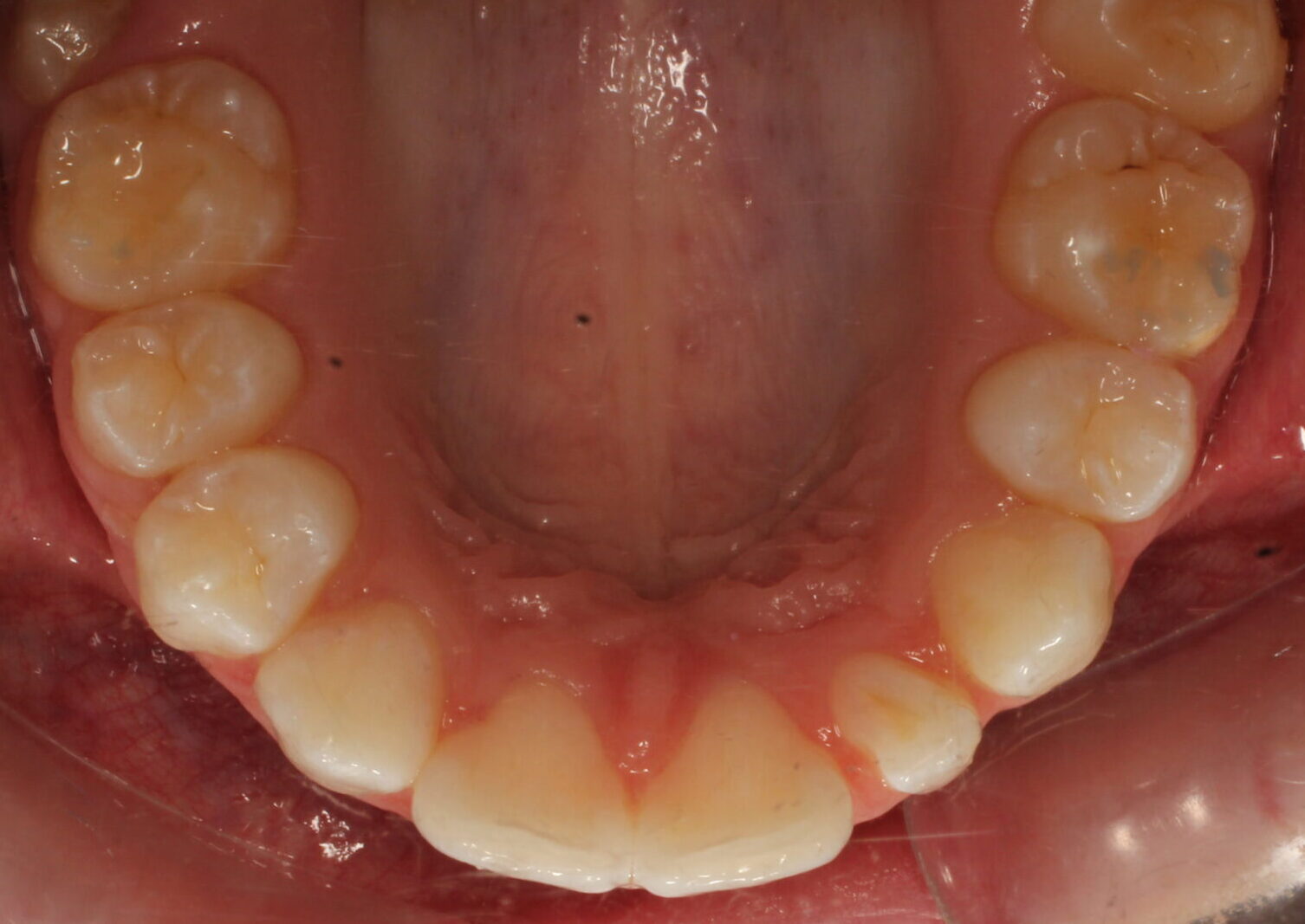 After braces upper teeth