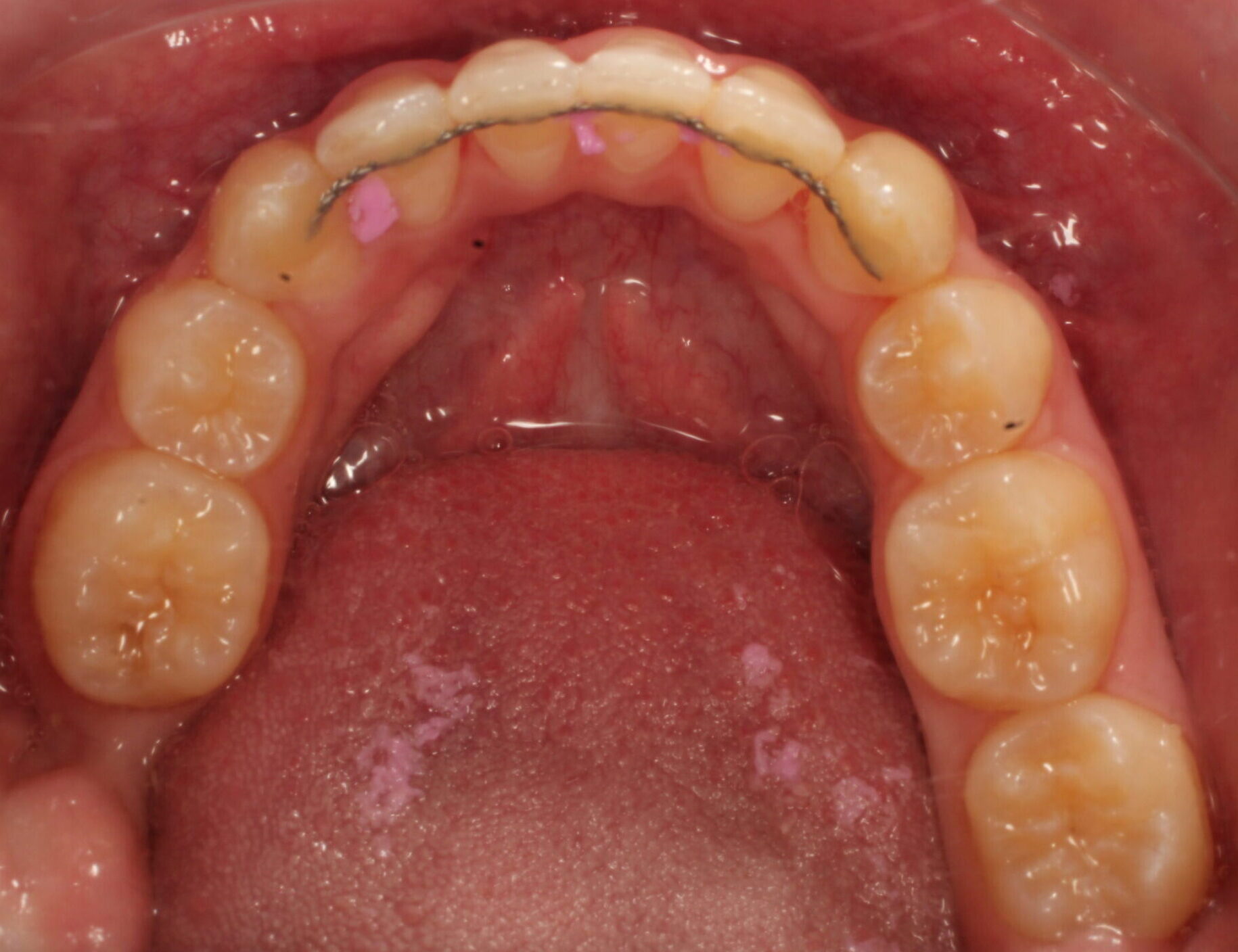 After braces lower teeth