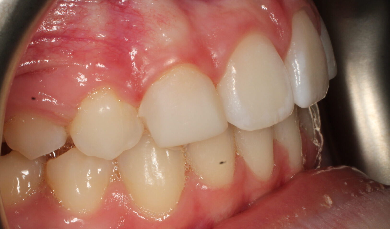 After braces right teeth