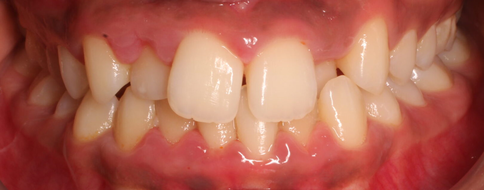 Before braces front teeth