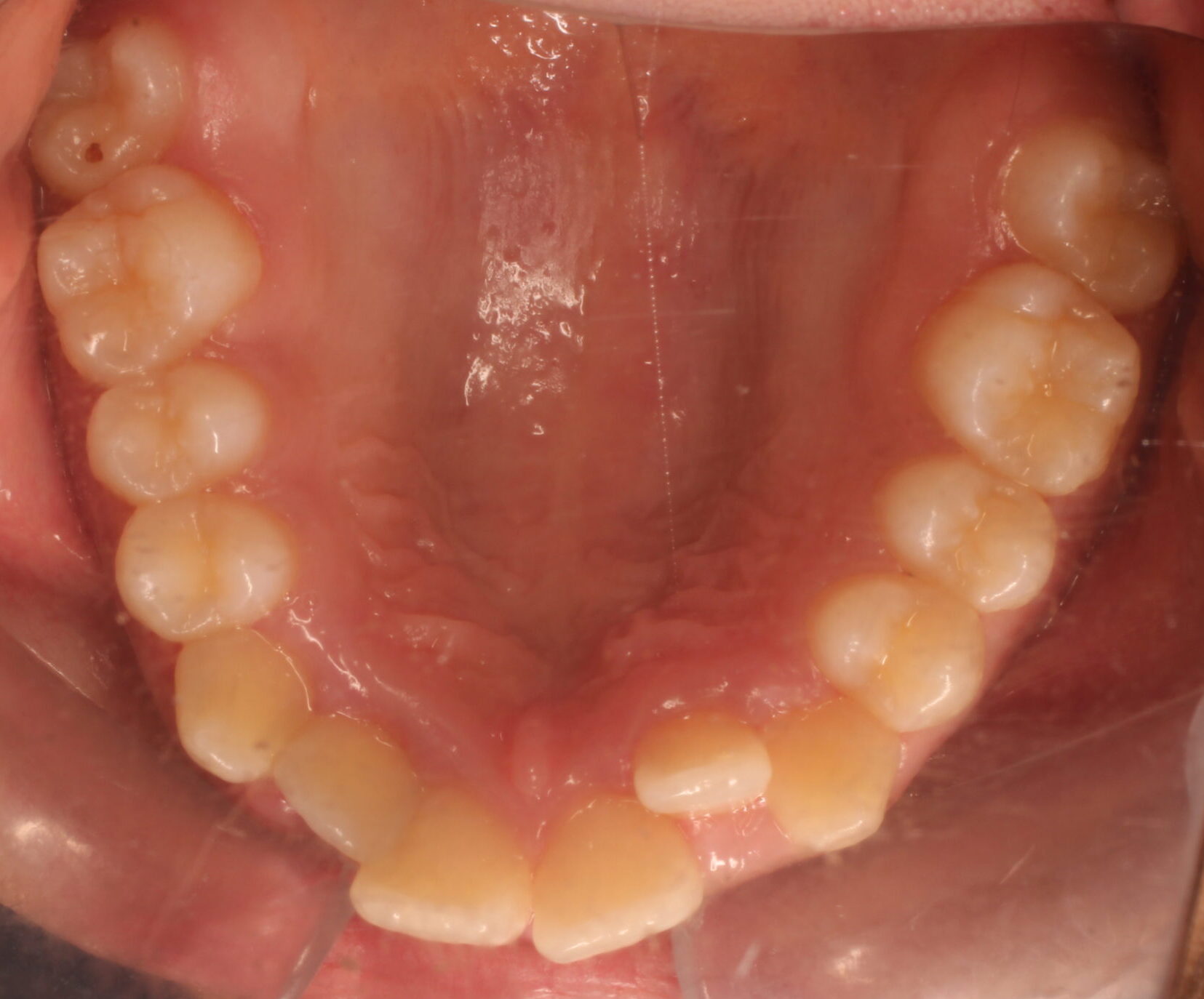 Before braces upper teeth