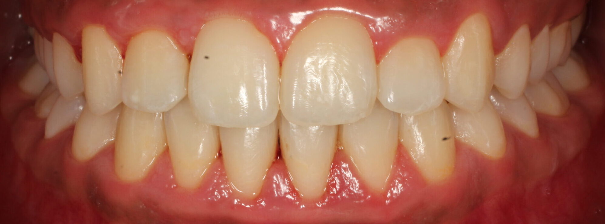 After braces front teeth
