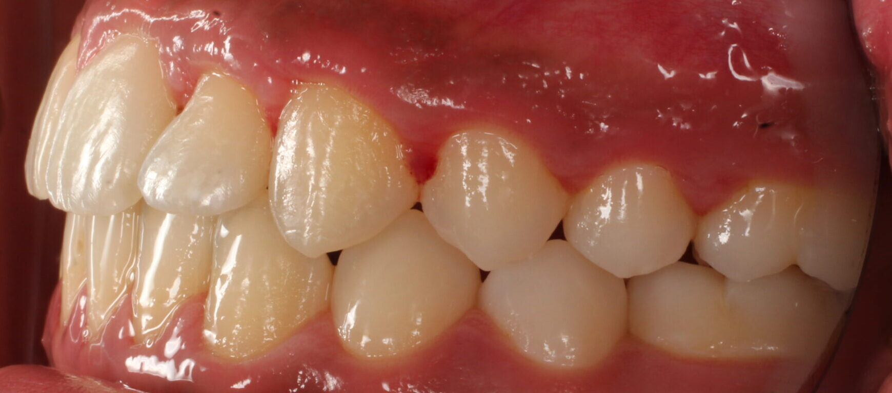 After braces left teeth