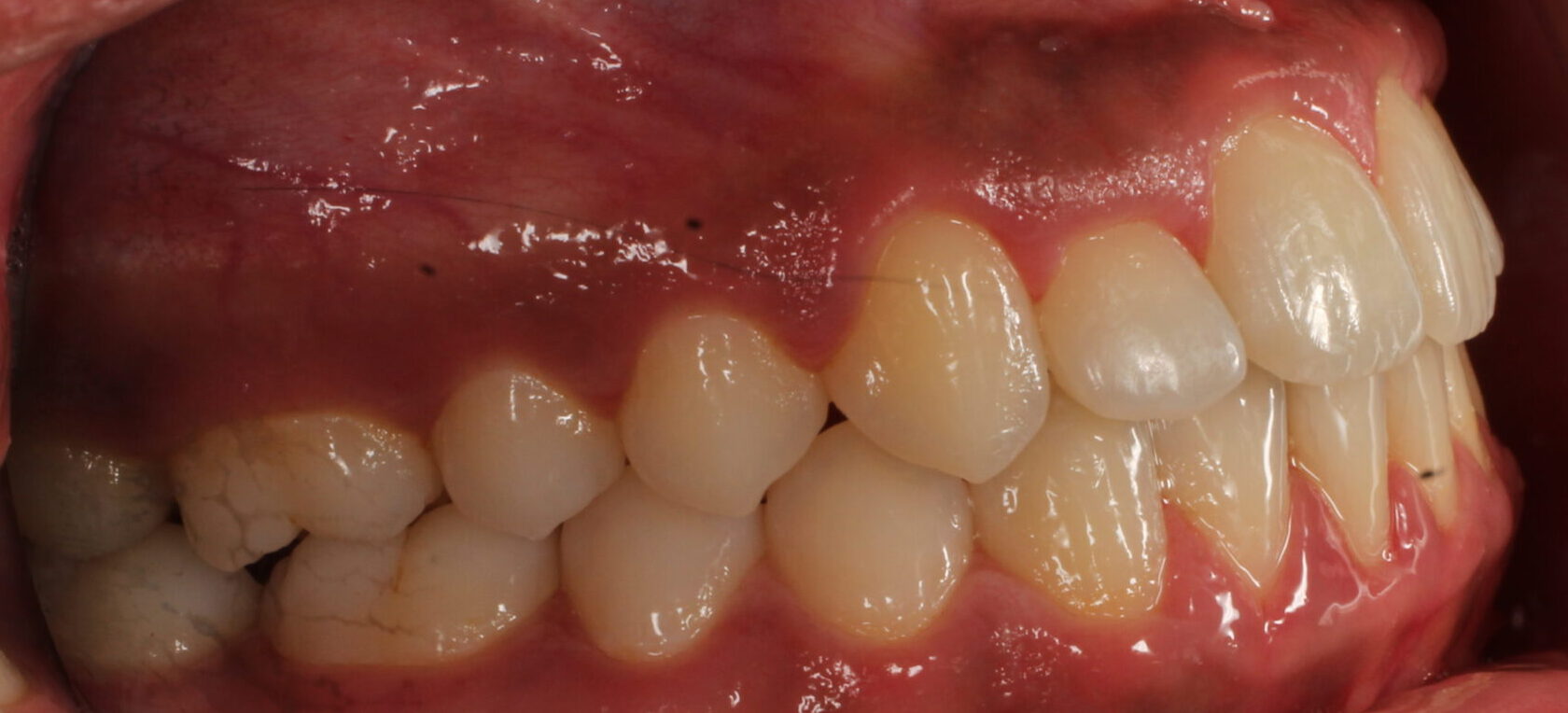 After braces right teeth