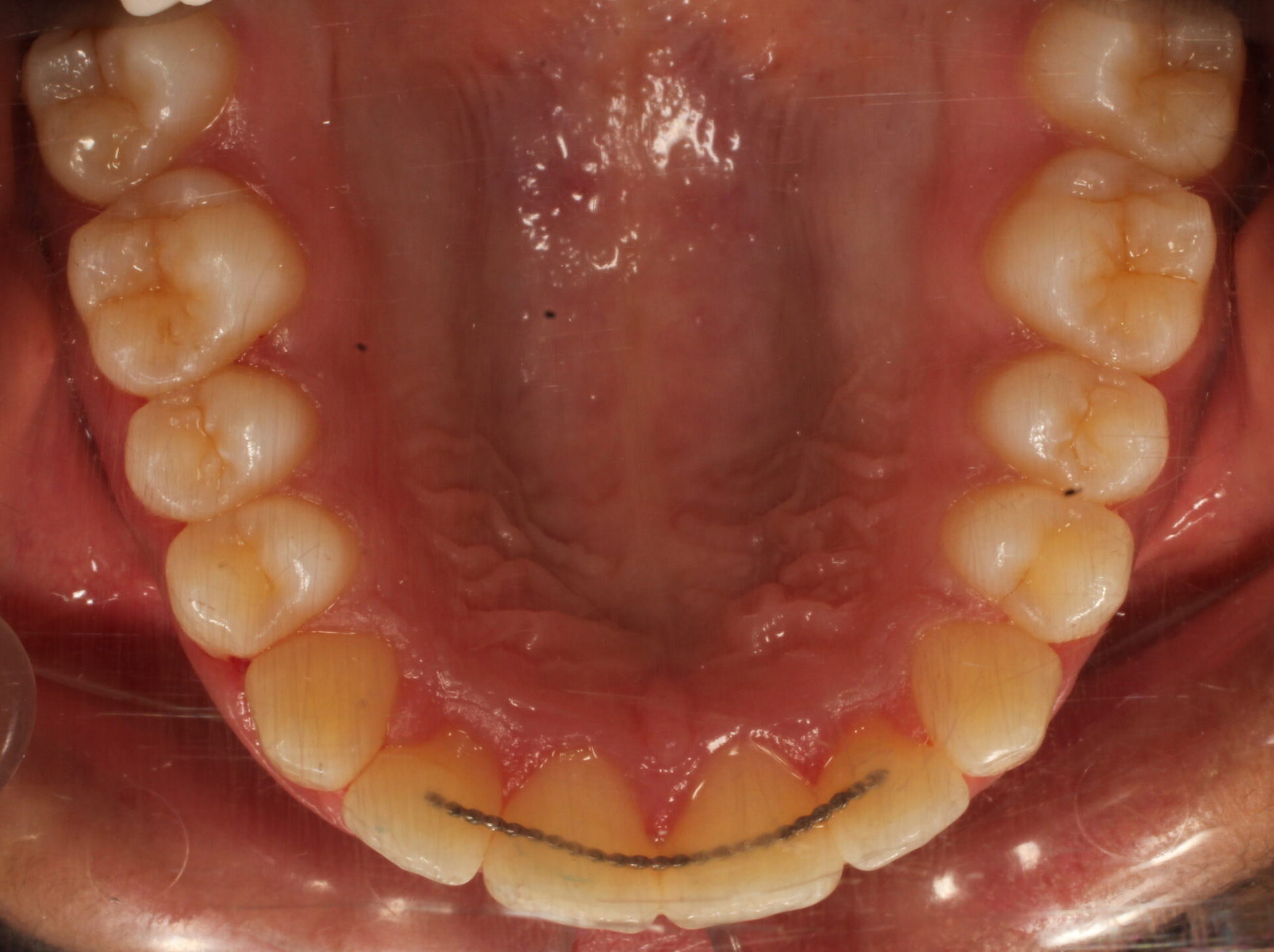After braces upper teeth