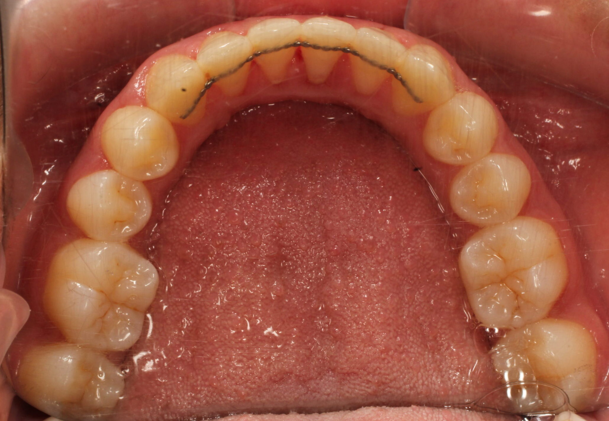 After braces lower teeth