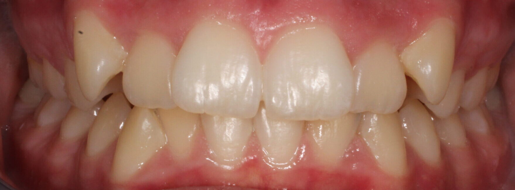 Before braces front teeth