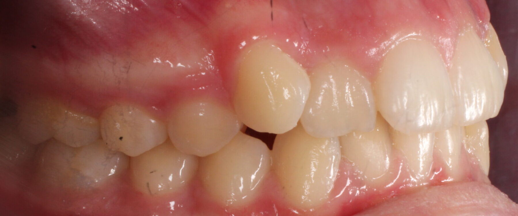Before braces right teeth