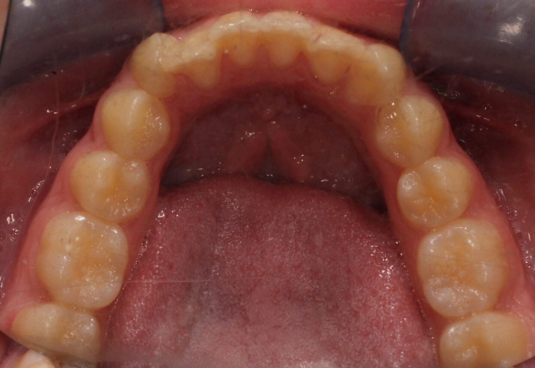 Before braces lower teeth