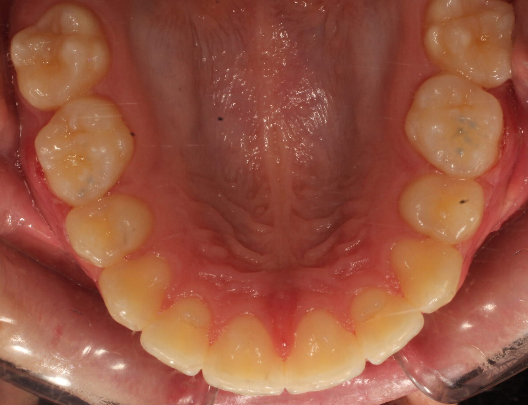 After braces upper teeth