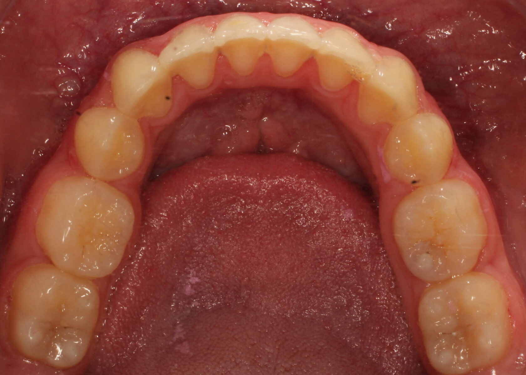 After braces lower teeth