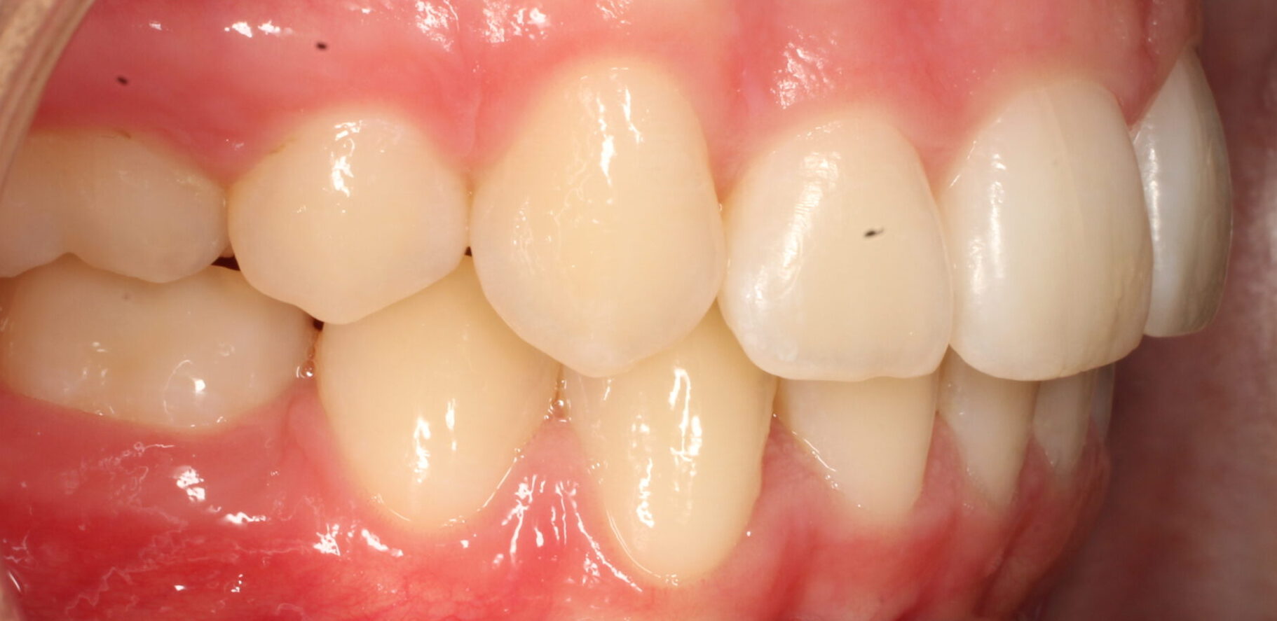 After braces right teeth
