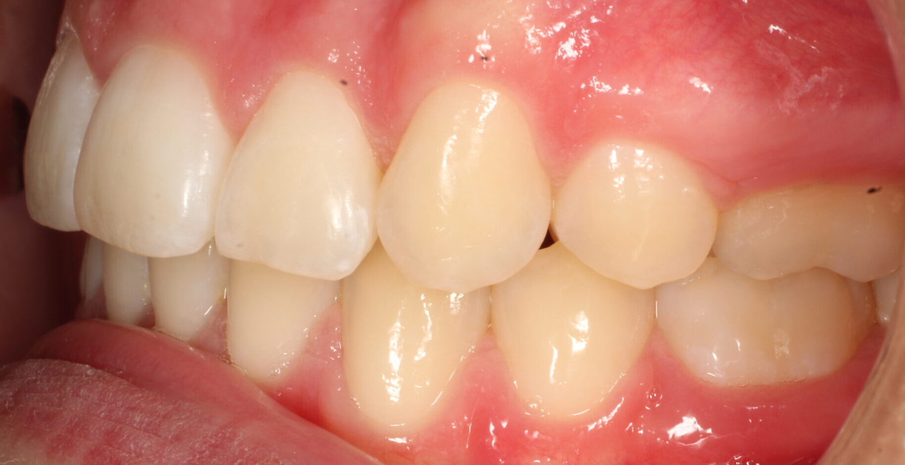 After braces left teeth
