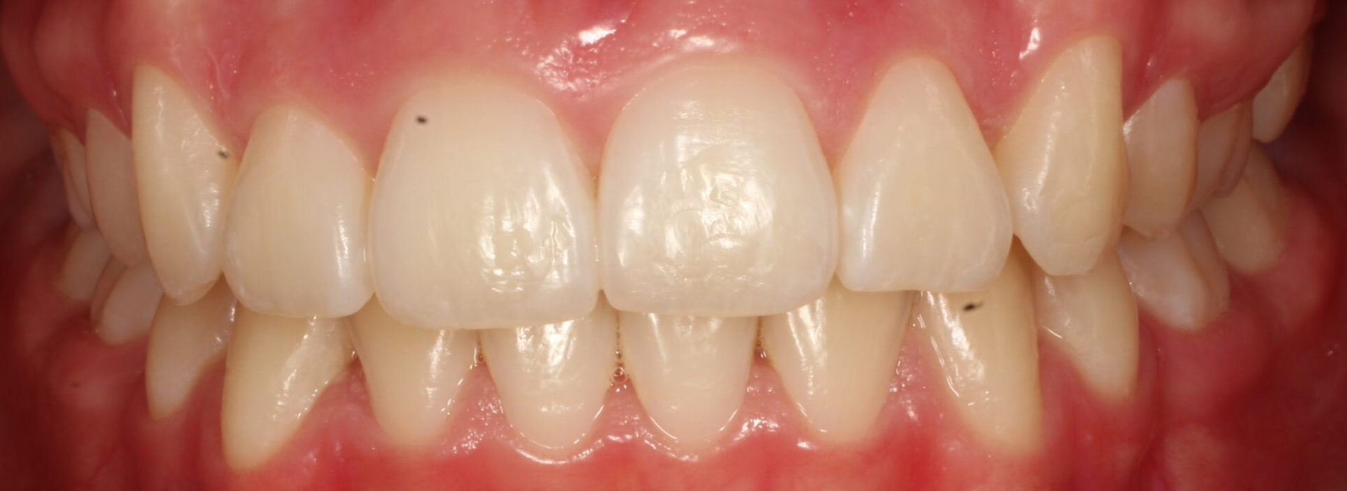 After braces front teeth
