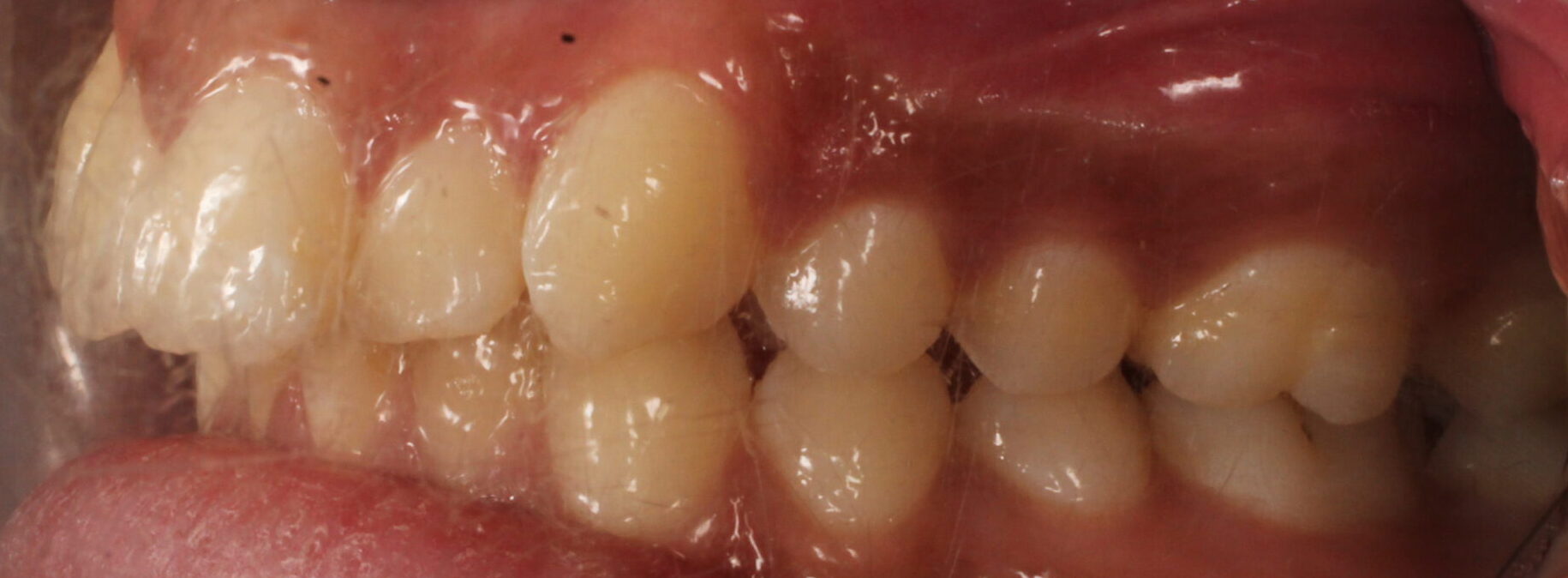 Before braces left teeth