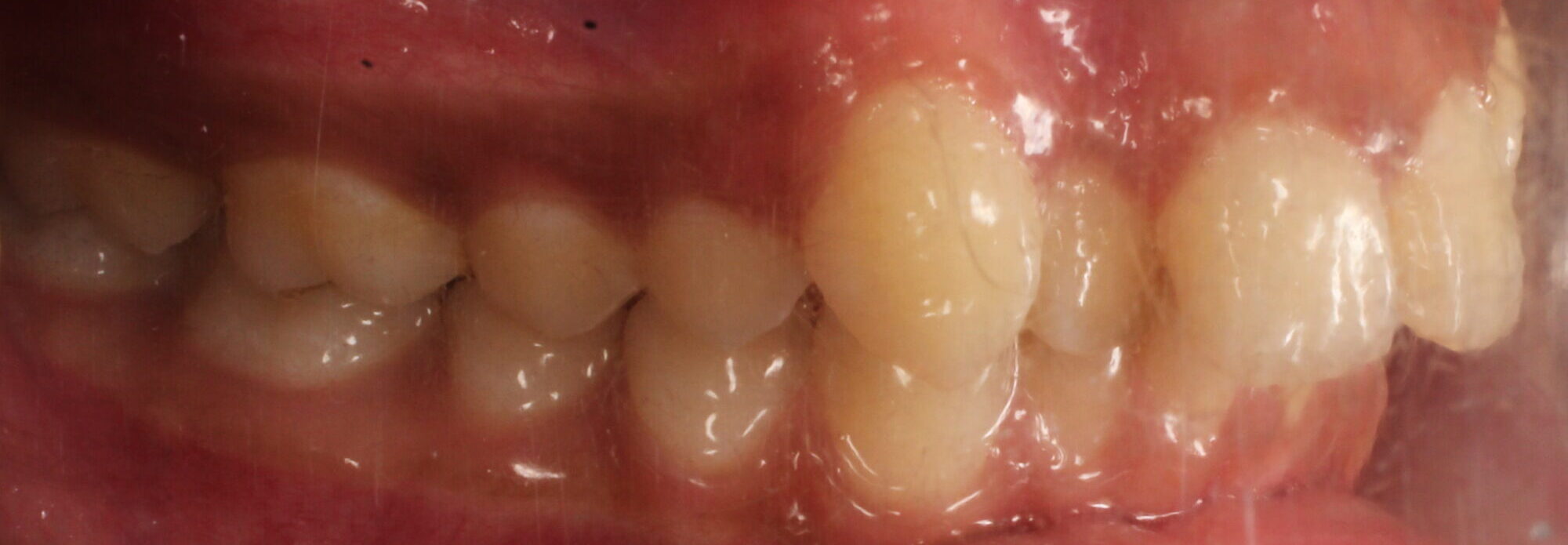 Before braces right teeth