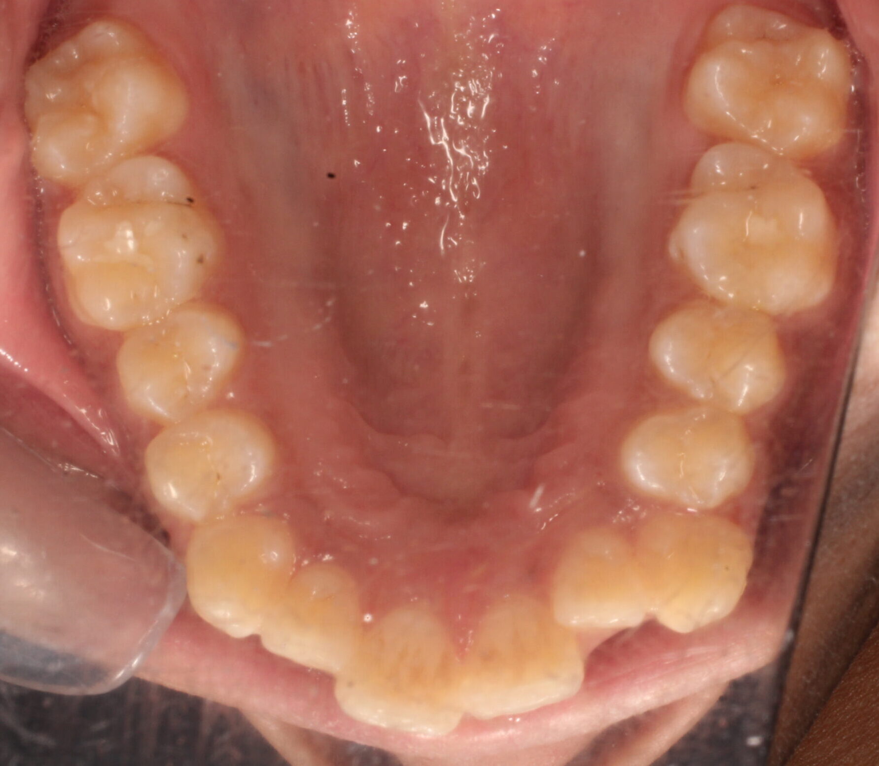 Before braces upper teeth