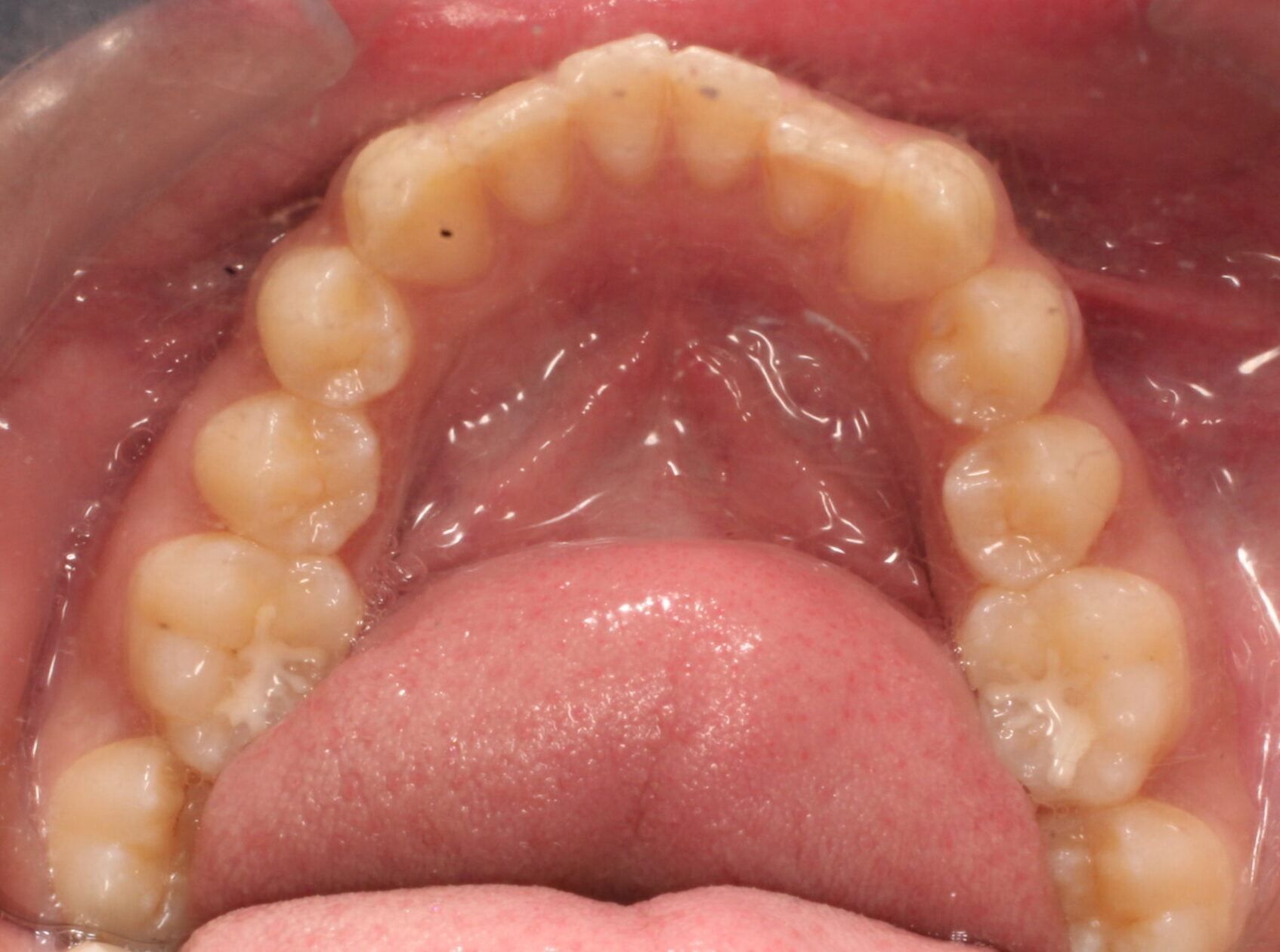 Before braces lower teeth