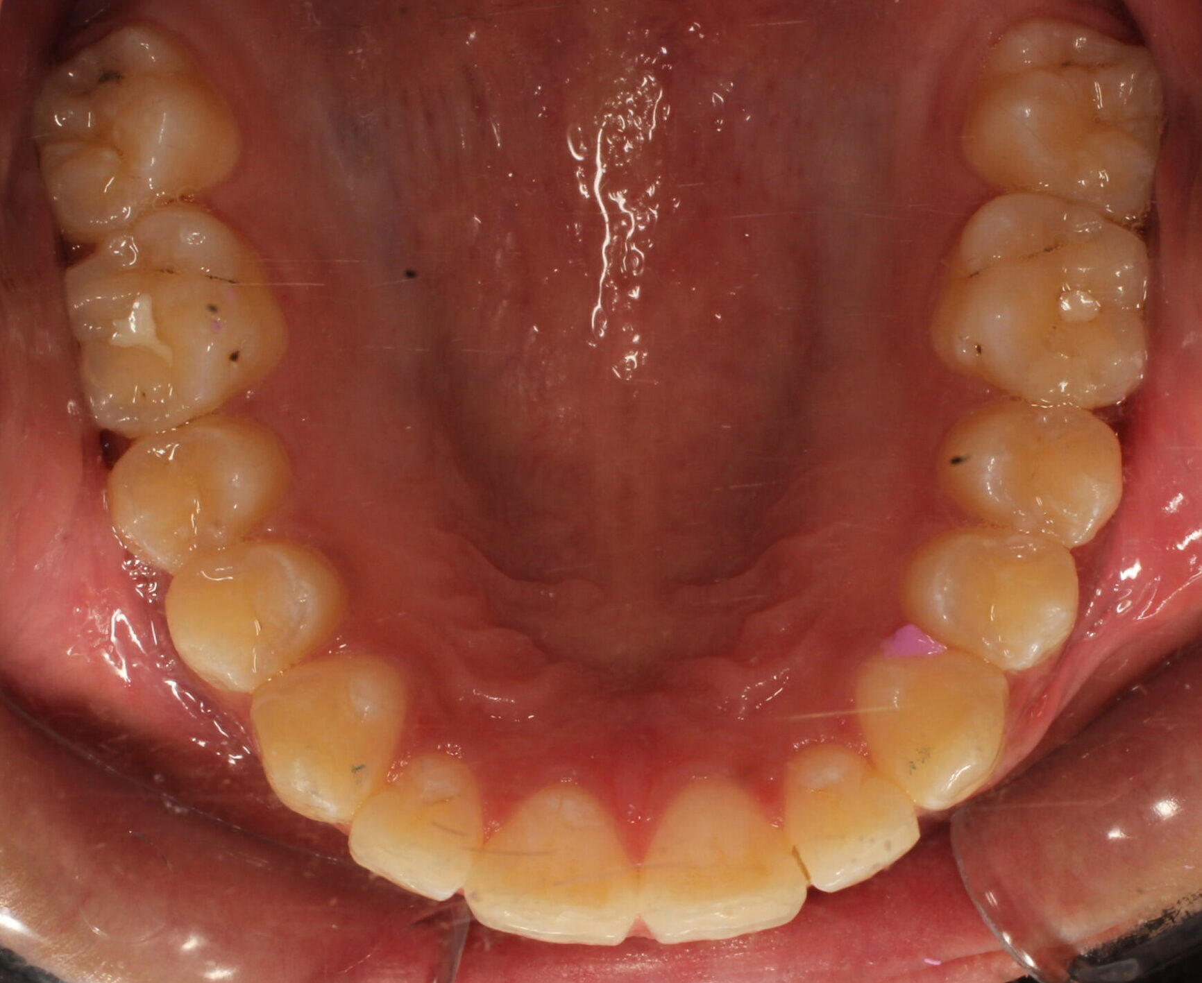 After braces upper teeth