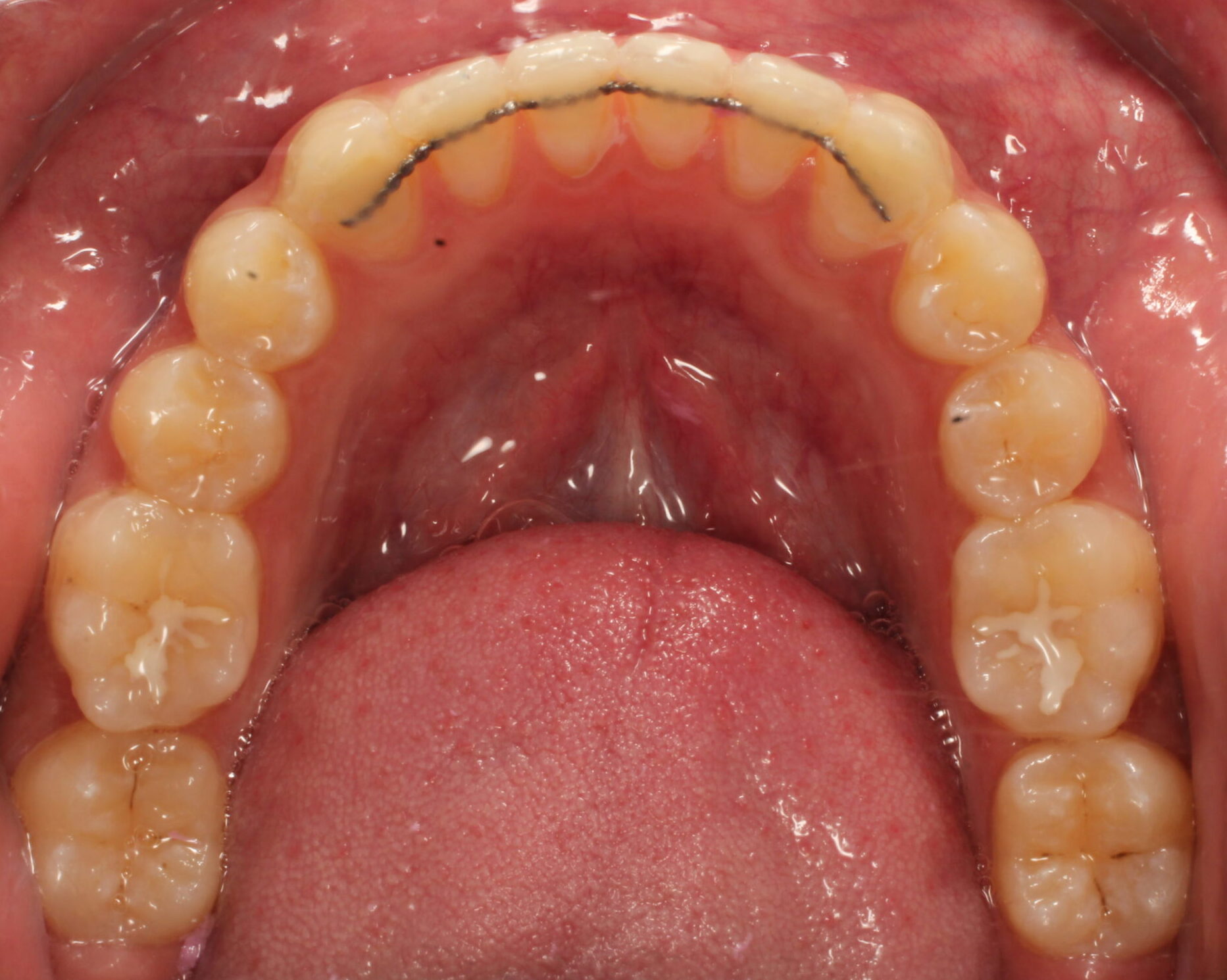 After braces lower teeth