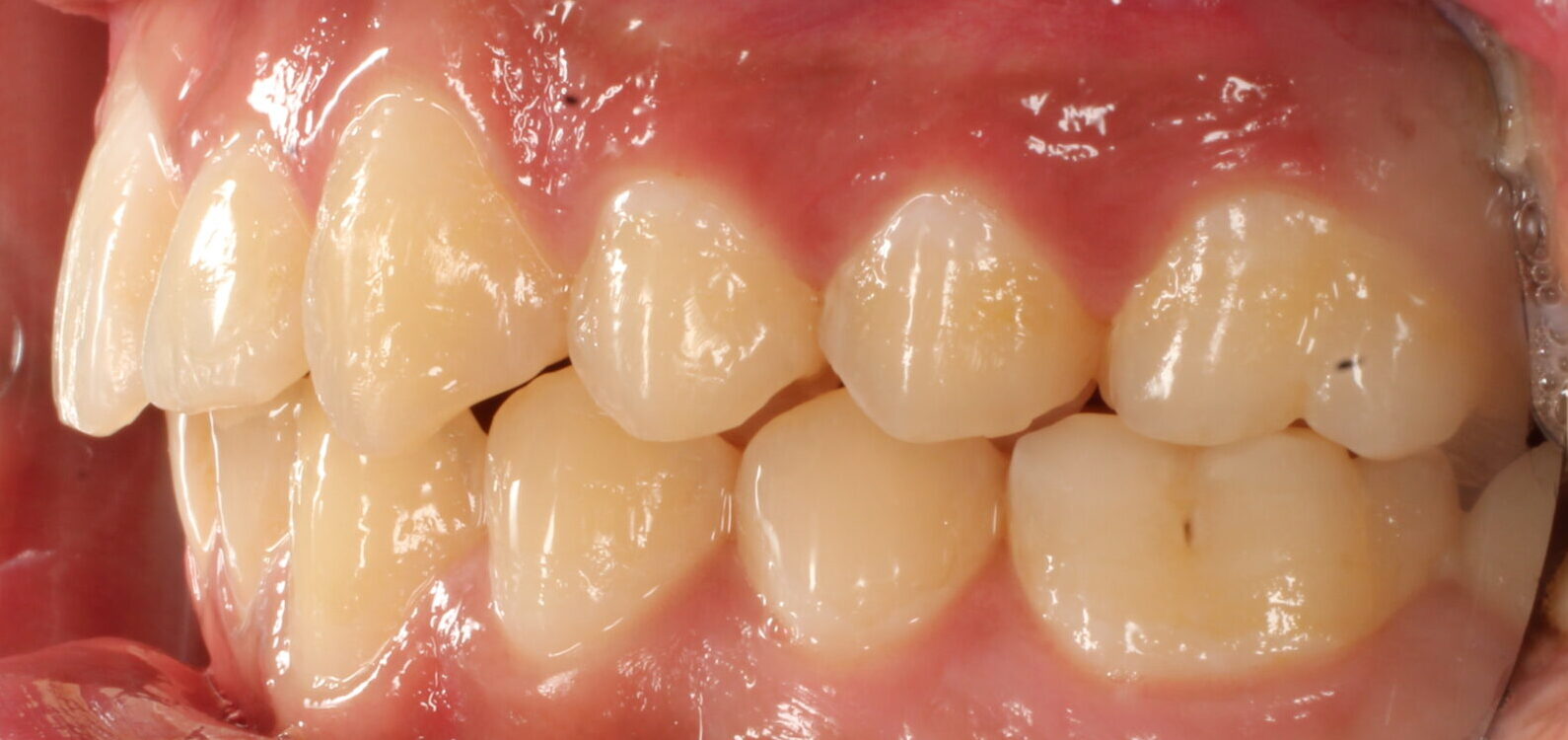 After braces left teeth