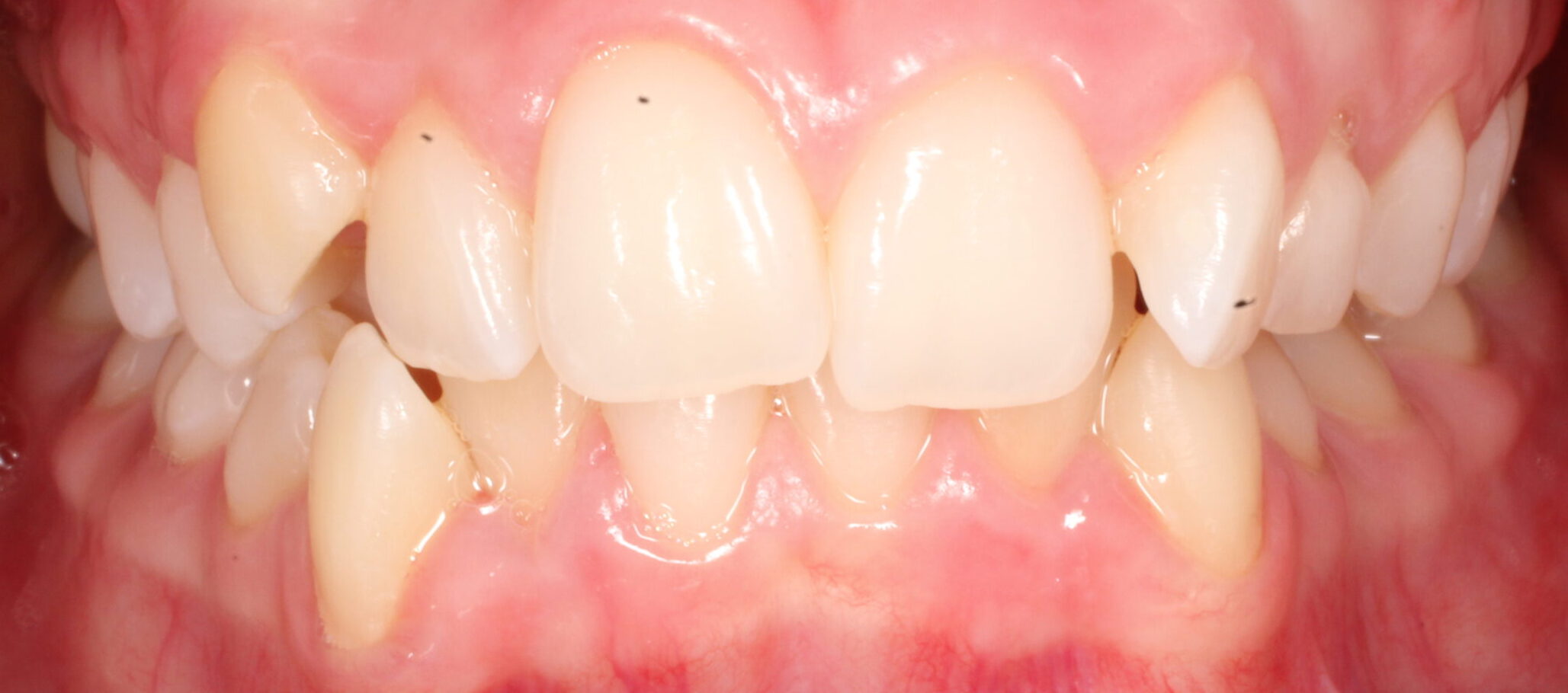 Before braces front teeth