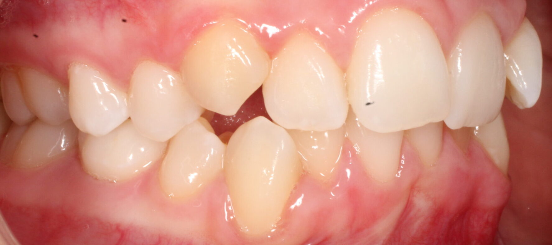 Before braces right teeth