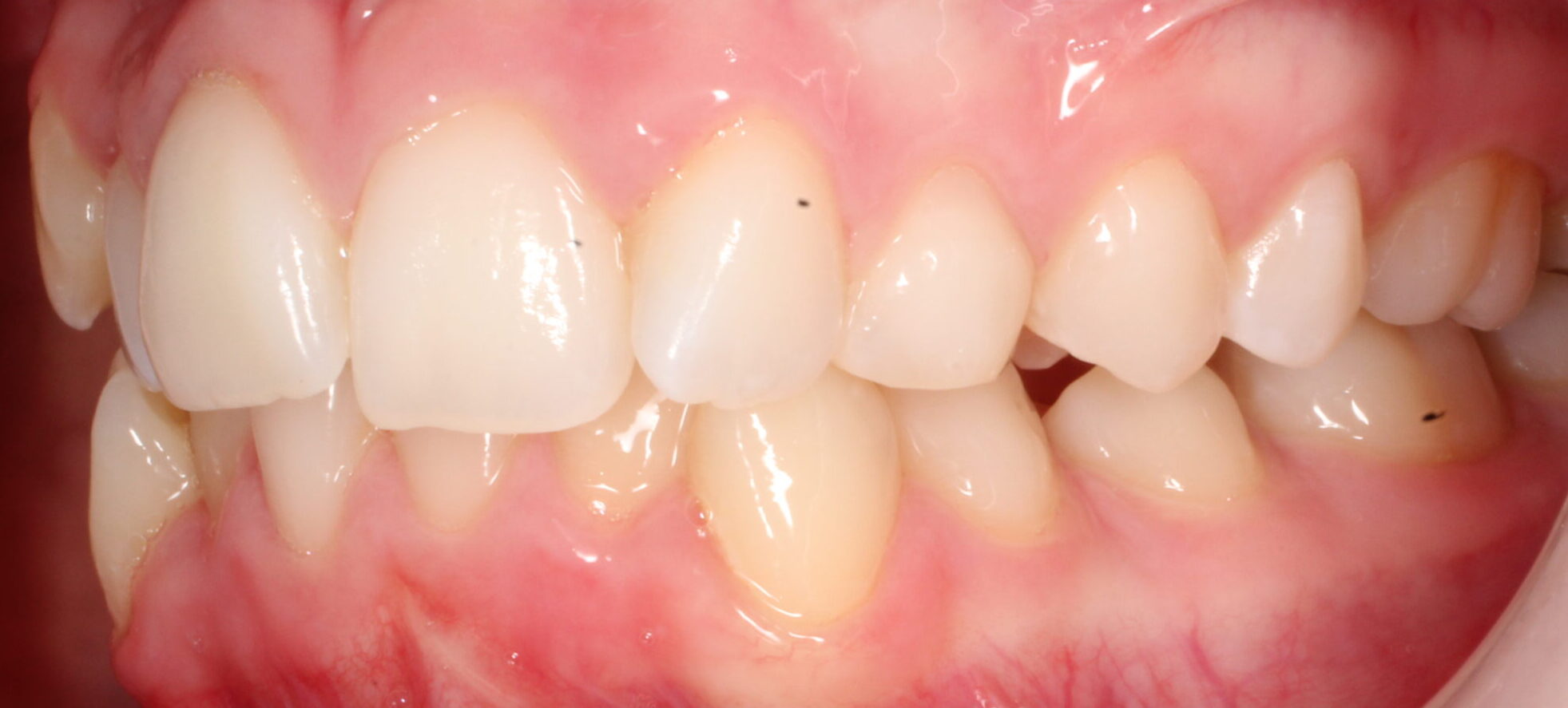 Before braces left teeth