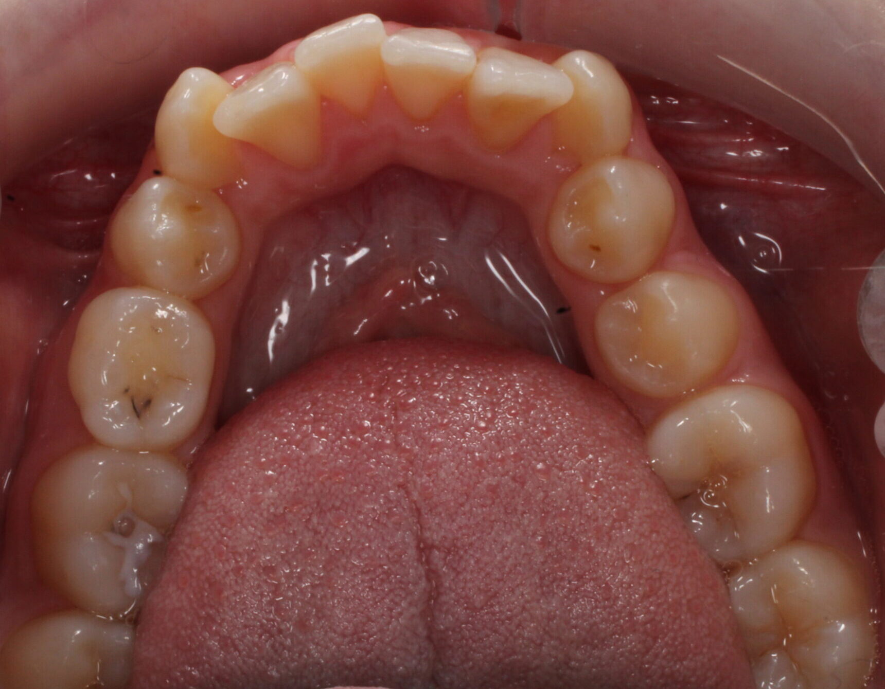 Before braces lower teeth