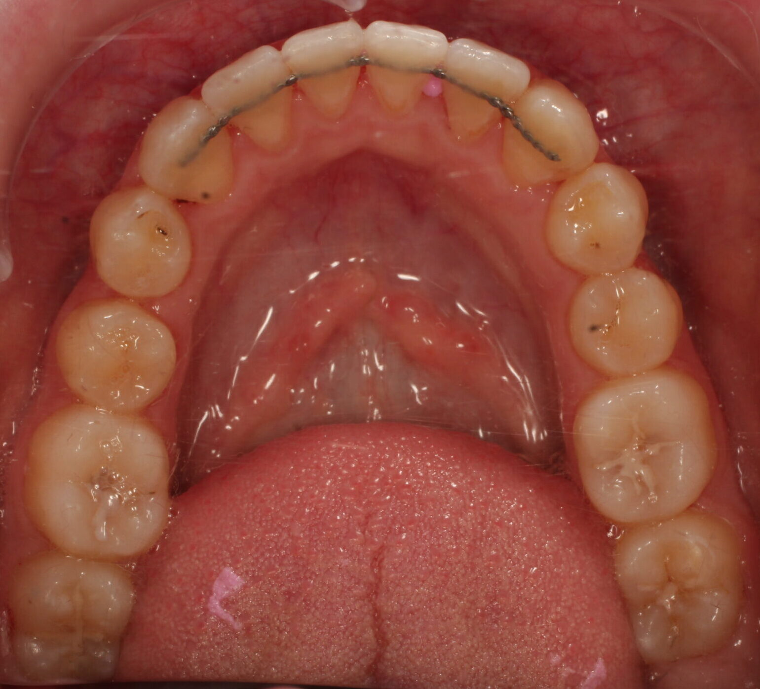 After braces lower teeth