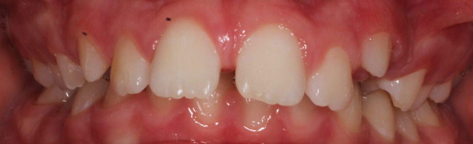 Before braces front teeth