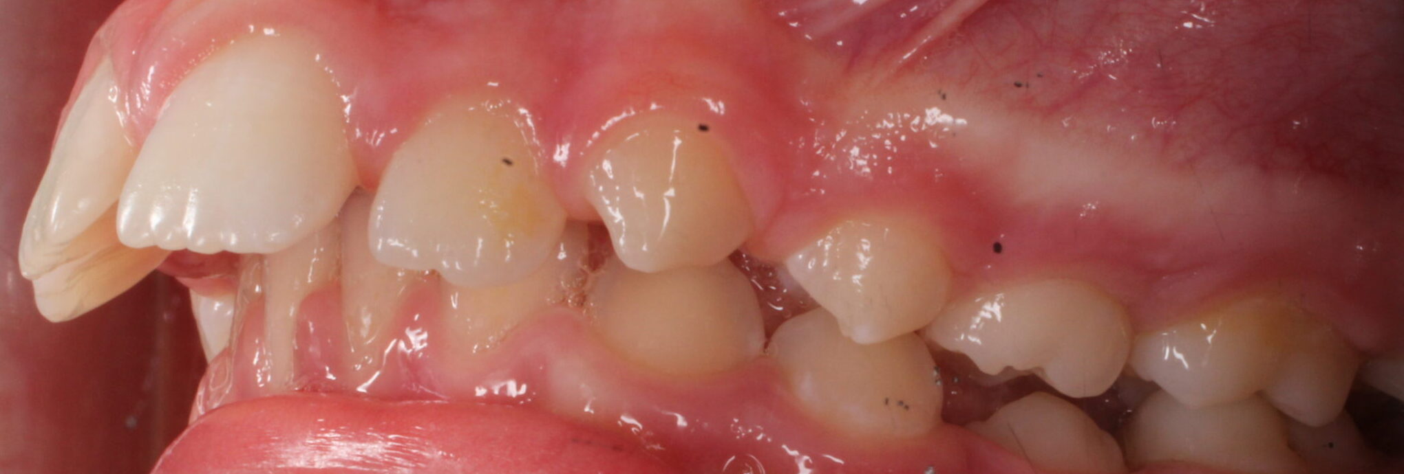 Before braces left teeth
