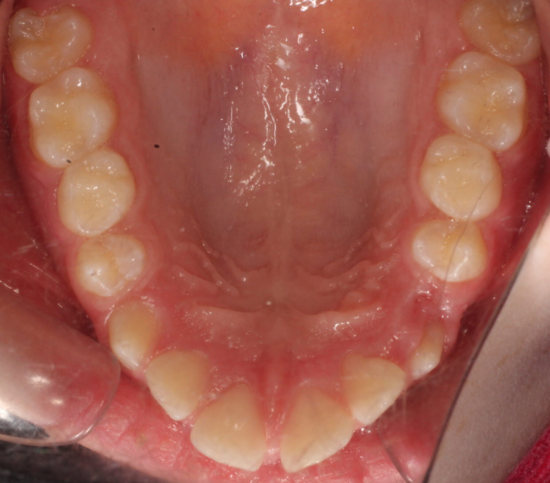 Before braces upper teeth