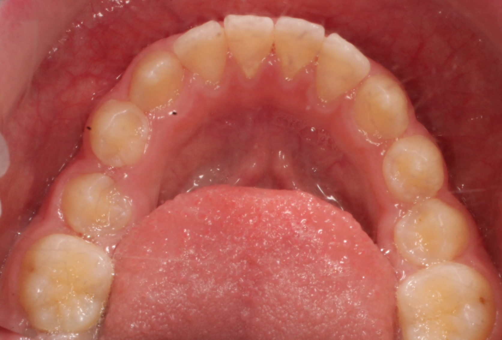 Before braces lower teeth