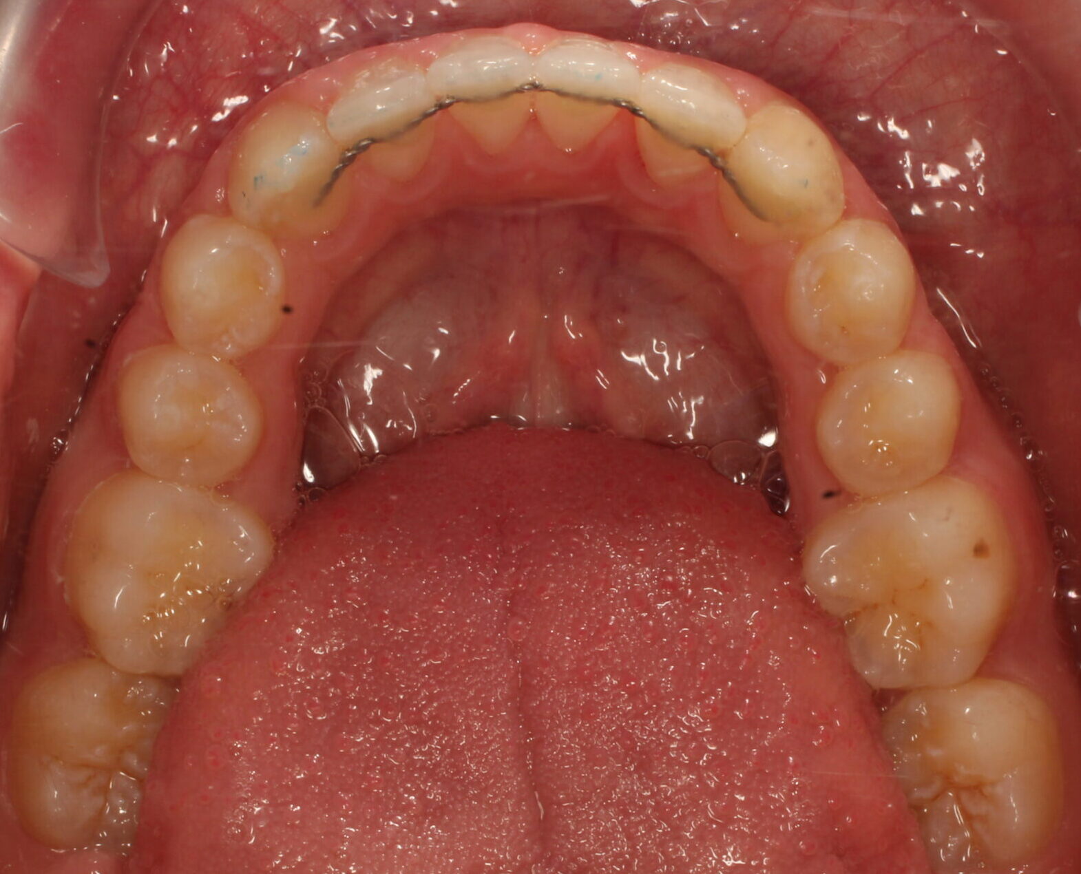 After braces lower teeth