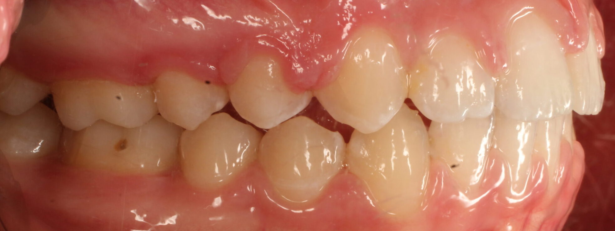 After braces right teeth