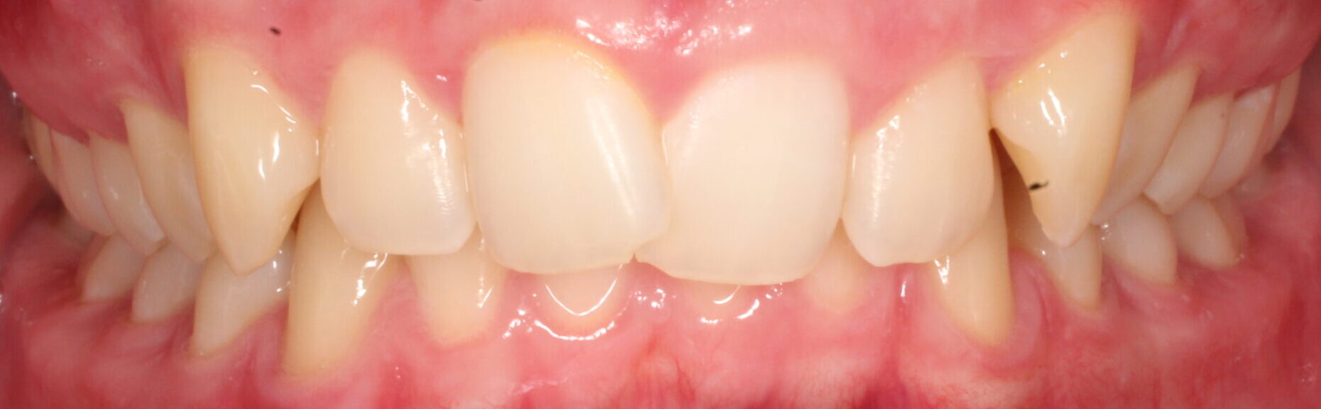 Before braces front teeth