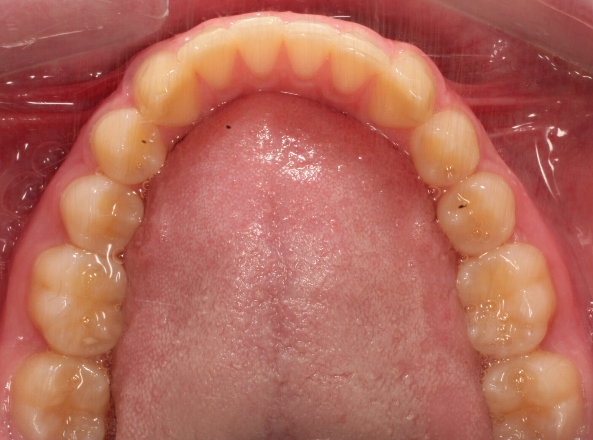Before braces lower teeth