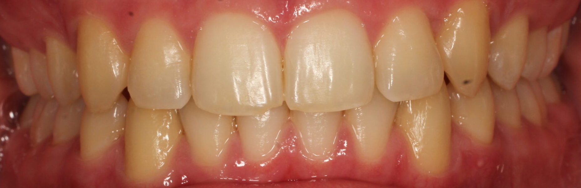 After braces front teeth