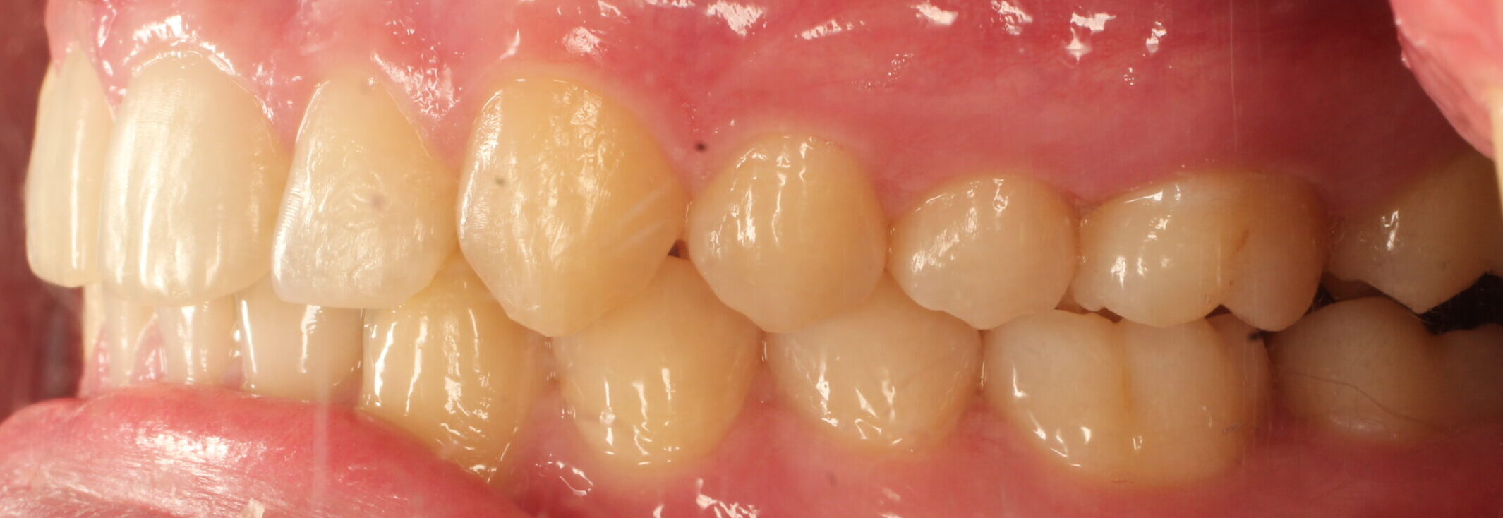 After braces left teeth